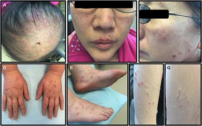 Case Report: The First Reported Case of Bullous Lichen Planus-Systemic Lupus Erythematosus Overlap Syndrome